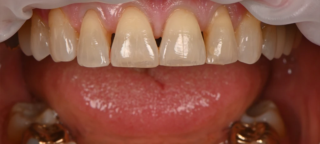 Before/After Smile | Radiant Dental Aesthetics | Rohnert Park, CA