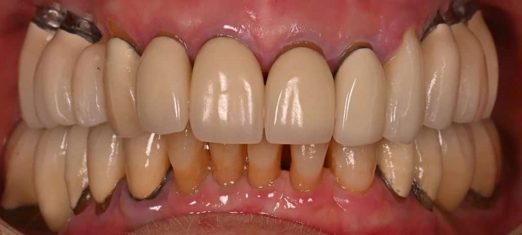 Before/After Smile | Radiant Dental Aesthetics | Rohnert Park, CA