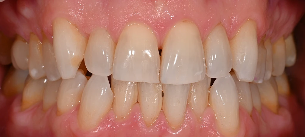 Before/After Smile | Radiant Dental Aesthetics | Rohnert Park, CA