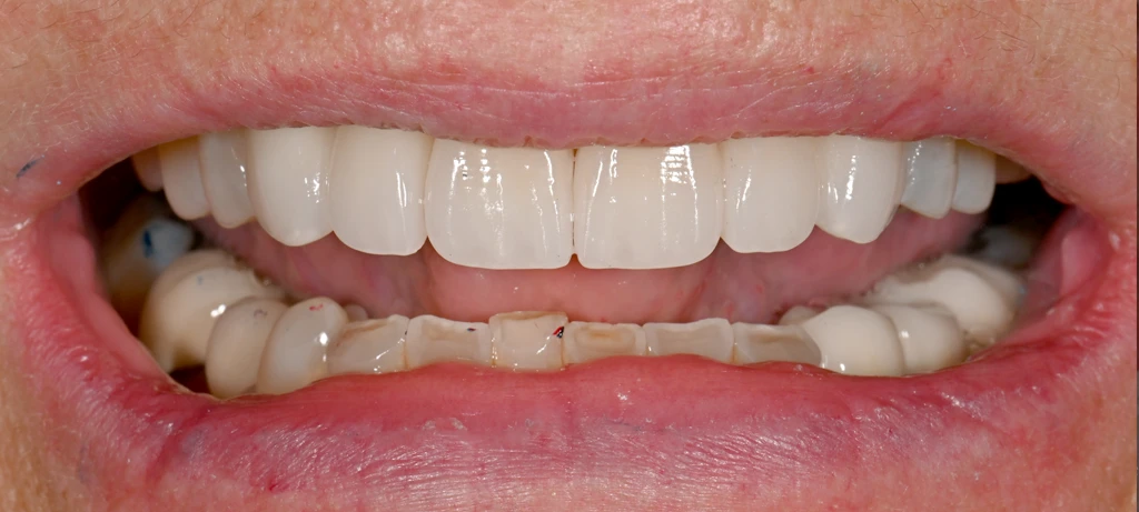 Before/After Smile | Radiant Dental Aesthetics | Rohnert Park, CA