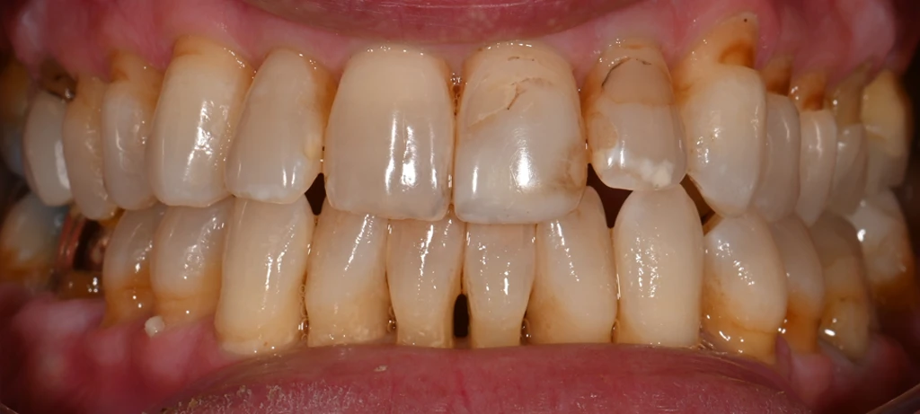 Before/After Smile | Radiant Dental Aesthetics | Rohnert Park, CA