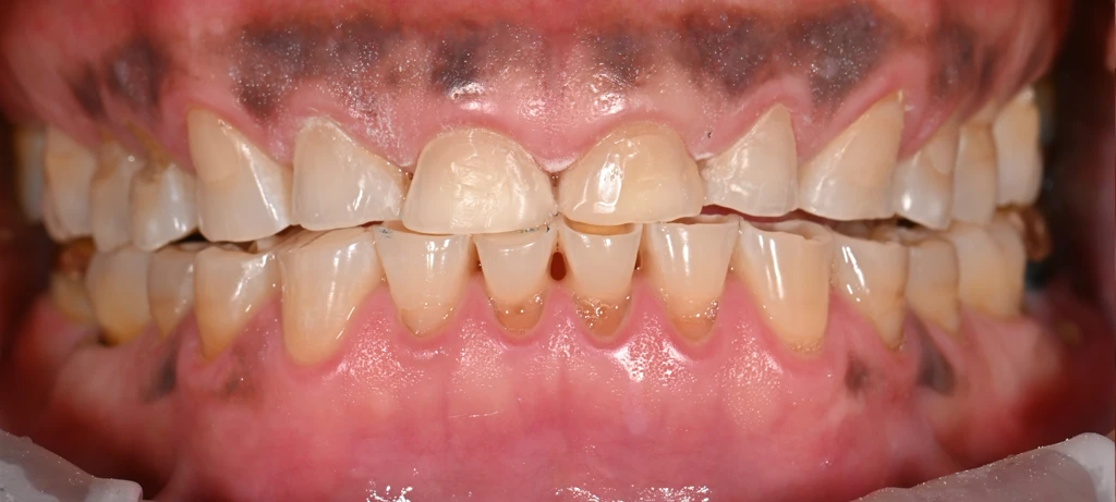 Before/After Smile | Radiant Dental Aesthetics | Rohnert Park, CA