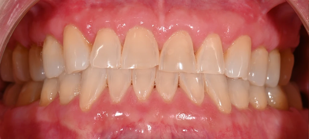 Before/After Smile | Radiant Dental Aesthetics | Rohnert Park, CA