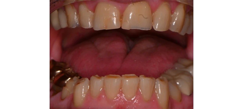 Before/After Smile | Radiant Dental Aesthetics | Rohnert Park, CA