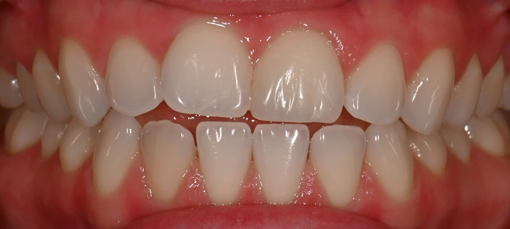 Before/After Smile | Radiant Dental Aesthetics | Rohnert Park, CA