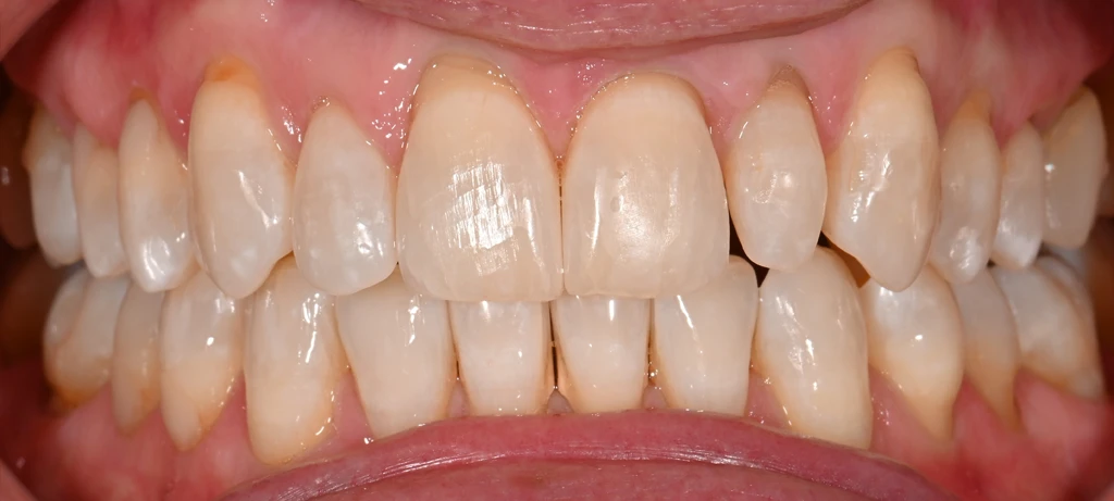 Before/After Smile | Radiant Dental Aesthetics | Rohnert Park, CA