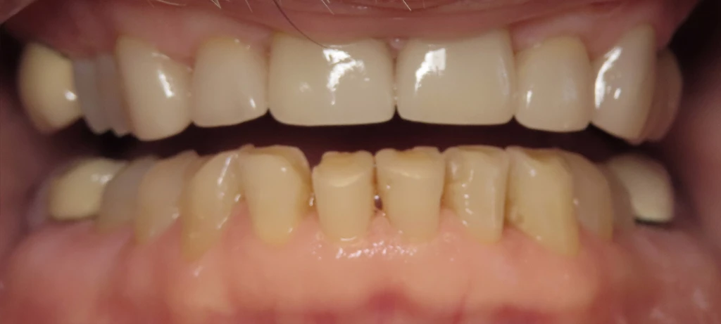 Before/After Smile | Radiant Dental Aesthetics | Rohnert Park, CA