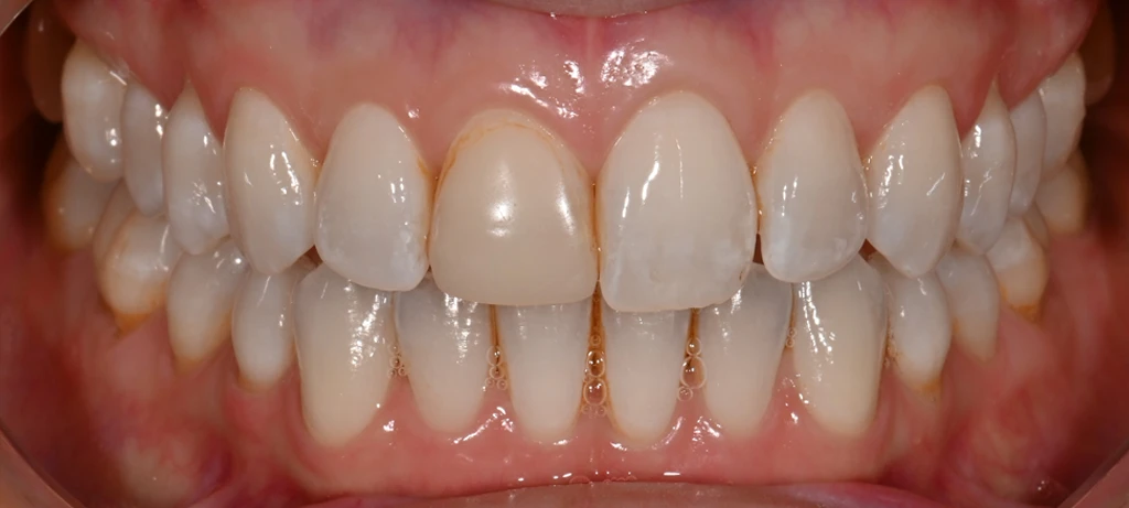 Before/After Smile | Radiant Dental Aesthetics | Rohnert Park, CA