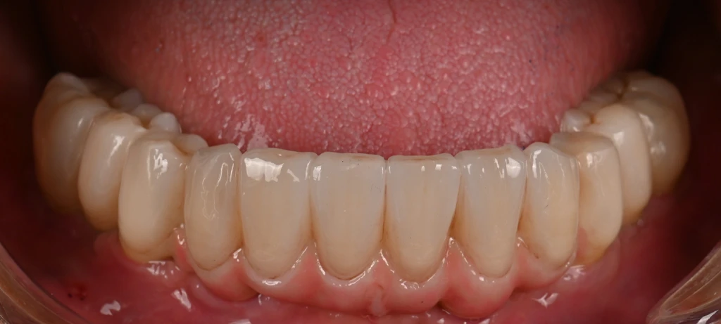 Before/After Smile | Radiant Dental Aesthetics | Rohnert Park, CA