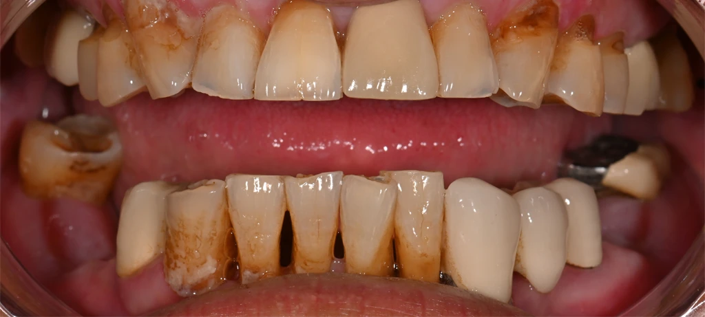 Before/After Smile | Radiant Dental Aesthetics | Rohnert Park, CA