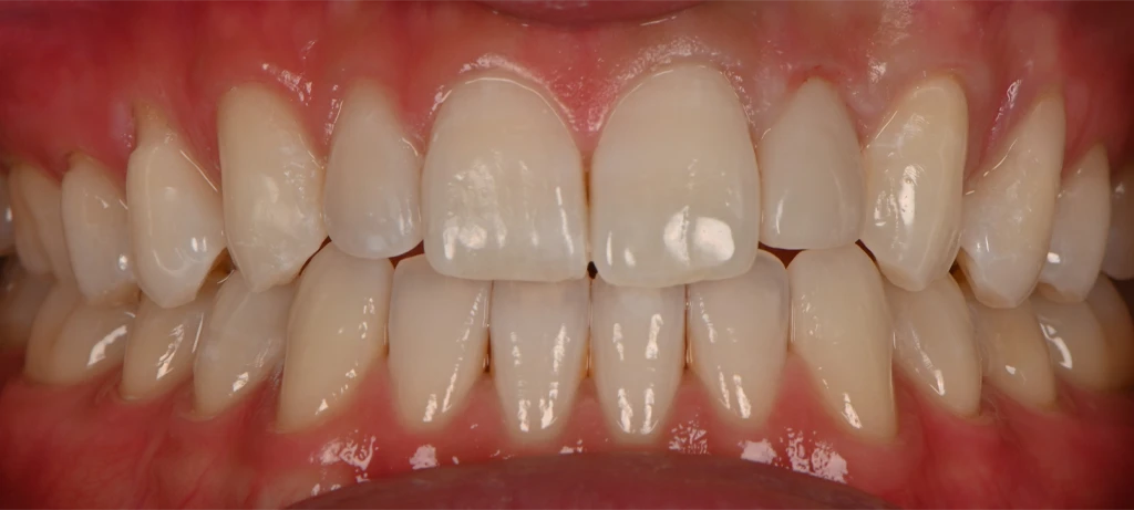 Invisalign | Before/After Smile | Radiant Dental Aesthetics | Rohnert Park, CA