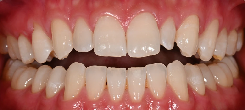 Invisalign | Before/After Smile | Radiant Dental Aesthetics | Rohnert Park, CA