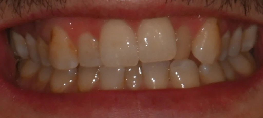 Invisalign | Before/After Smile | Radiant Dental Aesthetics | Rohnert Park, CA