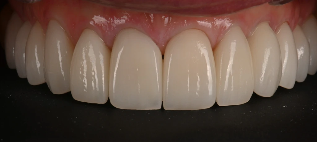 Vaneers + Implant | Before/After Smile | Radiant Dental Aesthetics | Rohnert Park, CA