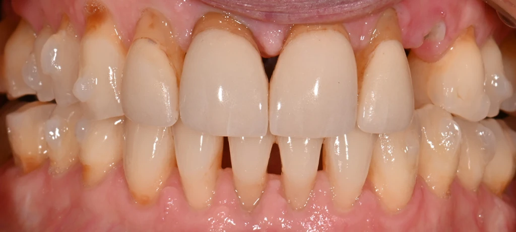 Vaneers + Implant | Before/After Smile | Radiant Dental Aesthetics | Rohnert Park, CA