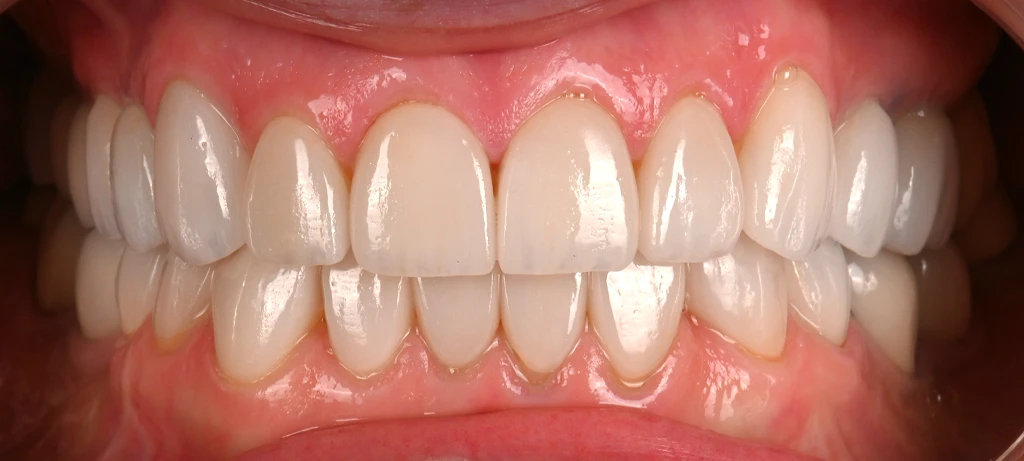 Vaneers | Before/After Smile | Radiant Dental Aesthetics | Rohnert Park, CA