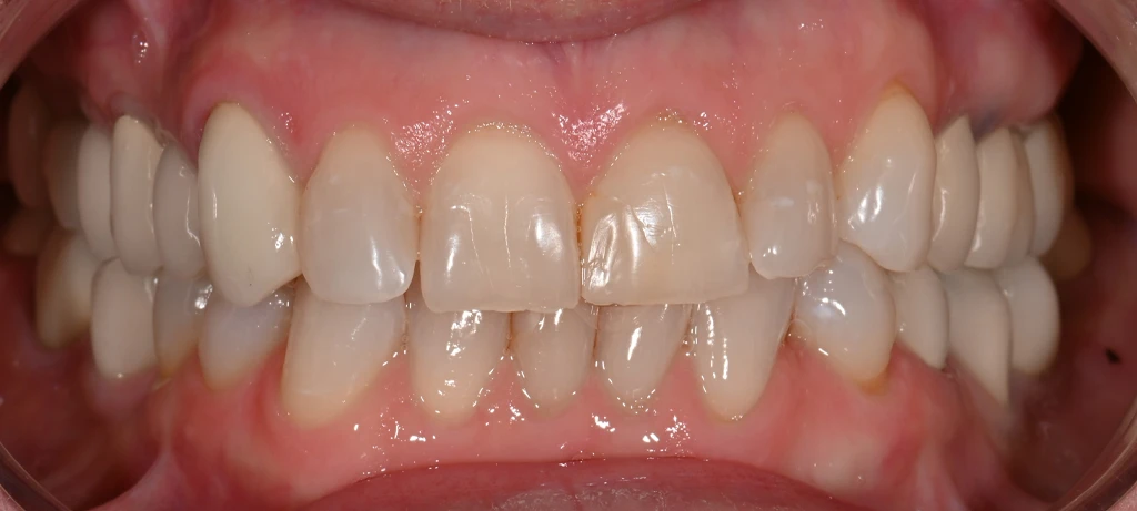 Vaneers | Before/After Smile | Radiant Dental Aesthetics | Rohnert Park, CA
